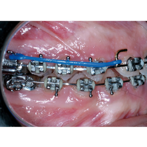 TIE-BACK LEONE. FIX ORTHODONTICS