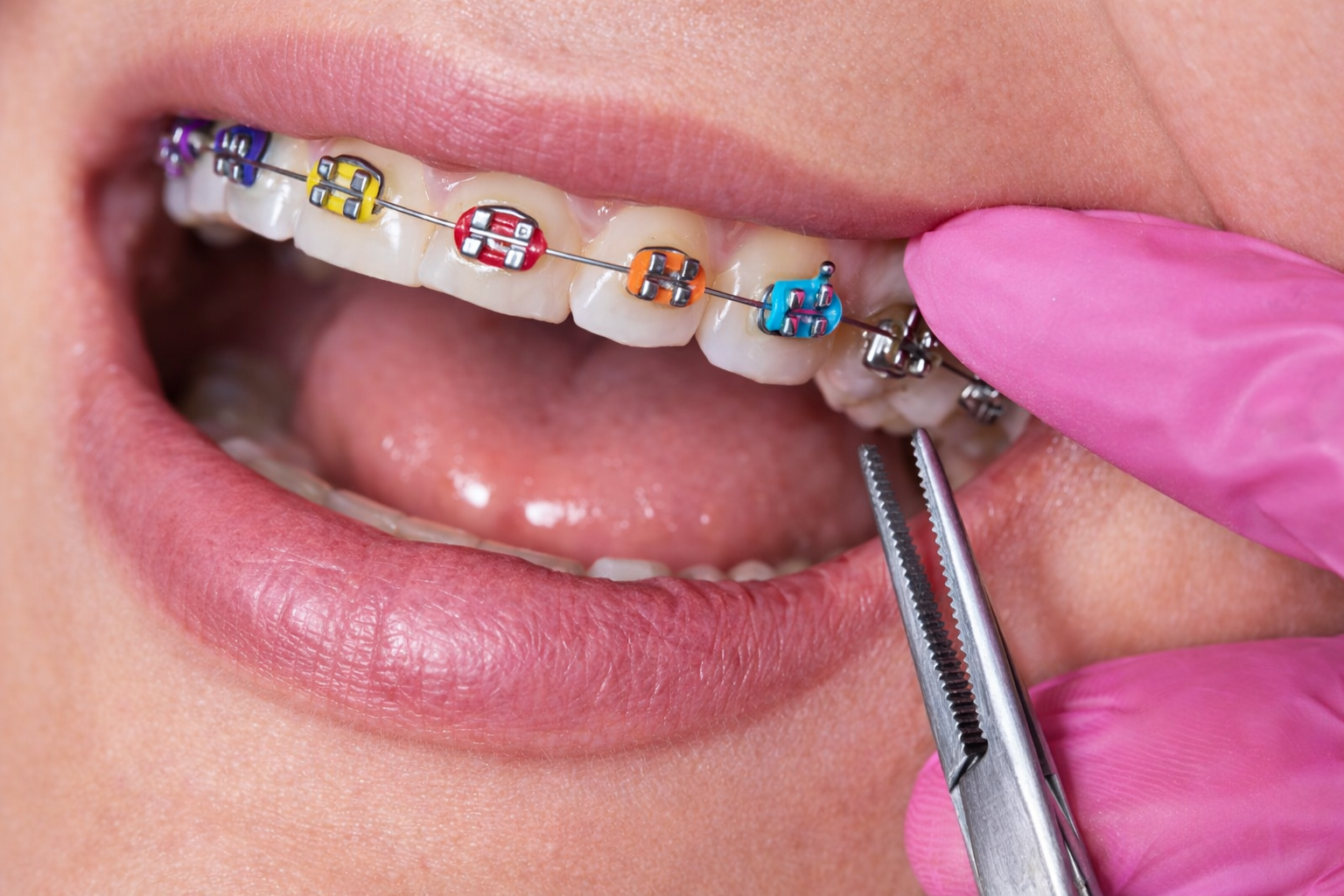 ligaduras elásticas ortodoncia